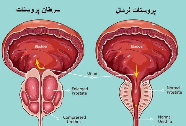 ارتباط بین رژیم غذایی و خطر سرطان پروستات